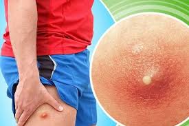 Психосоматика фурункулеза