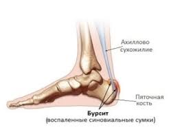 Психосоматика Ахиллобурсит