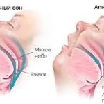 Психосоматика и Синдром обструктивного апноэ сна