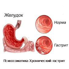 Психосоматика Хронический гастрит