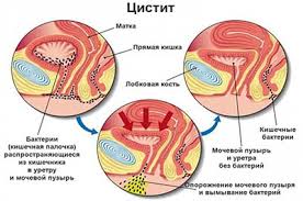 Психосоматика хронического цистита