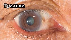 Психосоматика Трахома