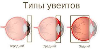 Психосоматика увеита