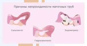Психосоматика Непроходимость маточных труб