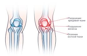 Психосоматика повреждения связок коленного сустава