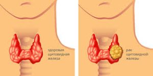 Психосоматика болезней щитовидной железы