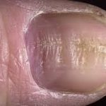 Психосоматика деформации ногтей