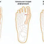 Психосоматика деформации стоп