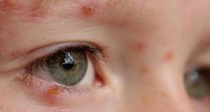 Психосоматика герпес на глазу