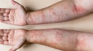 Психосоматика контактный дерматит