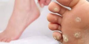 Психосоматика мозоль