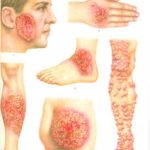 Психосоматика – Бластомикоза