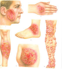 Психосоматика – Бластомикоза