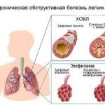 Психосоматика – Хронической обструктивной болезни лёгких (ХОБЛ)