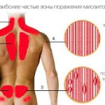 Психосоматика – Миозита