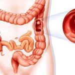 Психосоматика – Рака толстой и прямой кишки